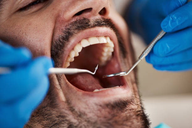 Best Emergency Wisdom Tooth Extraction in Lewisburg, KY